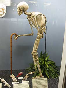 Human skeleton with spinal kyphosis at Museum of Osteology